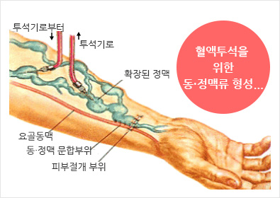 혈액투석을 위한 동정맥류 형성